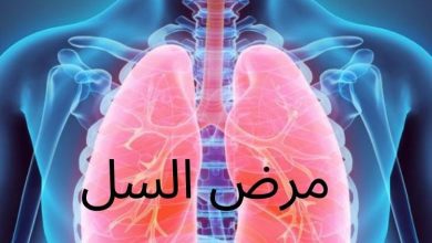 مرض السل(Tuberculosis)؛ أعراضه وأسبابه - شبكة فهرس